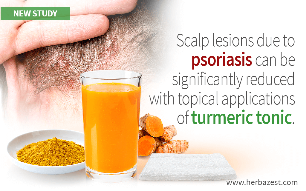 Scalp Psoriasis Can Be Improved with Turmeric Tonic